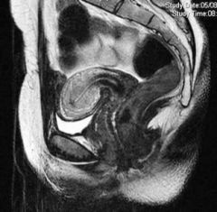  Mujer de 36 años acude a control anual con suginecólogo y se queja de que su período menstrual se ha alargado en dos o tresdías. Se muestra la MRI de pelvis y el macro del útero.