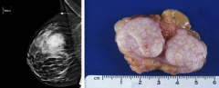  Mujer de 28 años de edad con masa palpable en loscuadrantes superiores de la glándula mamaria, móvil y no dolorosa. Se muestramamografía y macro del tumor.
