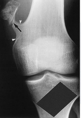  Un Joven de 22 años de edad se queja de dolor en laparte externa del muslo y se palapa una maza indurada. Se muestra radiografíade rodilla y el macro de la resección.