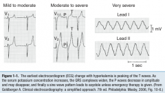 - Weakness and paralysis
- EKG --> tall peaked T waves, widening of QRS, prolongation of PR interval, loss of P waves, sine wave pattern
- Arrhythmias --> asystole, ventricular fibrillation