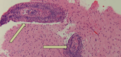 Primary angiitis (vasculitis) of CNS