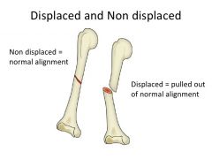 Non displaced fracture - bones aligned
Displaced fracture - bones out of alignment