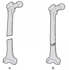 Complete fracture - bone broken through
Incomplete fracture - part of bone still attached