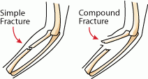 Open (compound) - penetrates skin (requires surgery; bone displaced)
Closed (simple) - most cases
