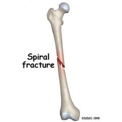 Ragged break occurs when excessive twisting forces are applied to a bone.
Common sports fractures