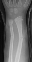 Bone breaks incompletely, much in the way a green twig breaks. Only one side of the shaft breaks; the other side bends.
Common in children whose bones have relatively more organic matrix and are more flexible than those of adults