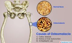 Soft bones
Ca 2+ is not deposited so bones are weak
Symptom - pain
