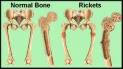 Most common
Bones deform - pelvis, skull, ribcage
Legs bow
Lack of vitamin D and/or Ca 2+
Occurs in children in 3rd world countries