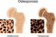 Older people-more so in women than men
Bone mass reduced
Bones porous and lighter
Spongy bone of spine is the most vulnerable
Sex hormones restrain the osteoclast activity
In menopause: Lower osteocyte = Higher Osteoclast activity