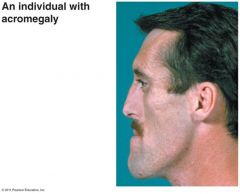 Acromegaly =