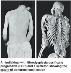 Fibrodysplasia ossificans progressiva (FOP) =