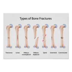Fractures are classified on the basis of: