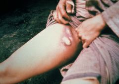 Disease:
Plague
first in lymphatics (see picture) 
can then lead to sepsis

Transmission and source: 
Fleas (rats and prairie dogs are reservoirs)