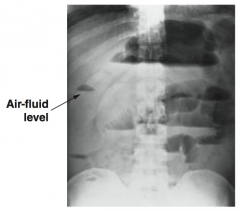 Distended loops of small bowel air-fluid levels on upright film