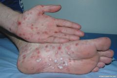 Coxsackievirus A infection
Rocky mountain spottet fever
Secondary Syphilis

you drive CARSS using your palms and soles