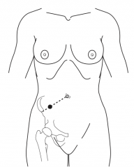 Point 1/3 from the ASIS to the umbilicus (often the point of maximal tenderness)