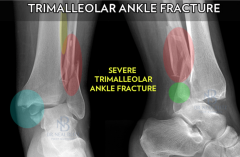 Trimalleolar fracture – both malleoli and inferior tibia fracture