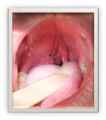 local pain (hard to swallow), tonsillar asymmetry with 1 tonsil usually displaced medially by the abscess