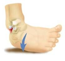 inversion sprain to lateral ligaments