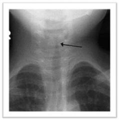 fever, inspiratory stridor, hoarse phonation, harsh barking cough. (brassy cough). steeple sign (x-ray)
