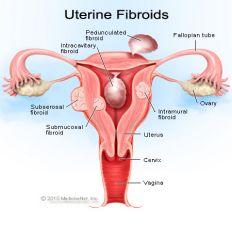 - grows outside of uterus with a stalk
- can twist and undergo torsion