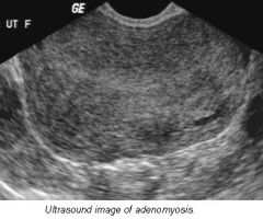 -rounded enlargement of uterus WITHOUT focal mass
-abnormal heterogenous myometrium
-poor definition of endomyometrial junction


-Doppler: hypervascularity throughout uterus