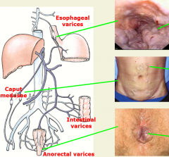 backpressure in liverexpansions of veins in intestines, esophagus, anorectal
backs all the way up to umbilical vein!


Varices