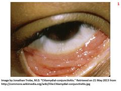 Chronic infection

cause blindness due to follicular conjunctivitis in Africa

ABC = Africa, Blindness, Chronic infection