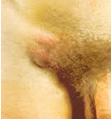 Lymphogranoloma venerum

small, painless, ulcers on genitals
--> swollen, painful ingiunal lymph nodes that ulcerate (budoes)

treat with doxycycline