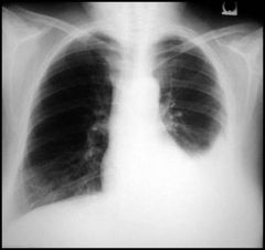 Why does pneumonia cause pleural effusion (exudation of fluid in pleural space)