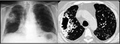 lung abscess in lung parenchyma