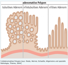 - echte Neoplasien aus epithelialem Schleimhautgewebe


- ca. 75 % aller Polypen (bei 3 % der Adenome ist bei Diagnosestellung eine Schleimhautinfiltration nachweisbar)


- Können über Epitheldysplasien entarten (Adenom-Karzinom-Sequenz).

...