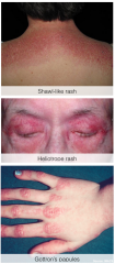Shawl-like rash
Lilac-coloured rash (mostly around eyes)
Gottron's papules (raised erythema over MCP and PIP)