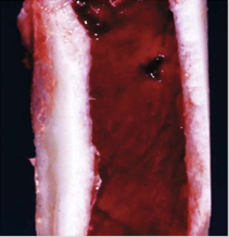 Acute lymphoid leukemia, with neoplastic large lymphocytes.

When you see this, think of the bone marrow!