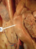 Last segment of the small intestine. Controls flow into the large intestine, and includes Peyer's patches.


 