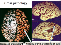 - Decreased brain weight
- Atrophy of gyri
- Widening of sulci
- Increased size of lateral ventricles