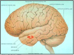 - Especially in temporal lobe (amygdala and hippocampus)
- Neocortex: senile plaques