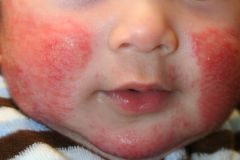 o   Pruritic, excoriated inflammation ofskin, common on face and flexor surfaces of allergy prone patients