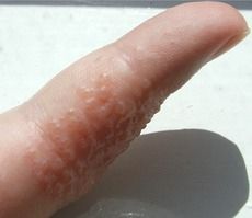 o   Vesicular eczema 
o   Caused by allergen like-friction,cold, excessive exposure to water