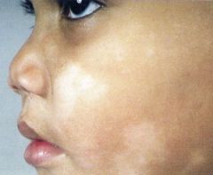 o   Hypopigmented macules on face andneck of preadolescents 
 o   Triggered by sun exposure, frequentbatching and heat
