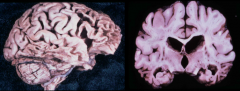 Distinctive atrophy: severe frontal and temporal atrophy ("Knife-edge"), sparing of parietal and occipital lobes