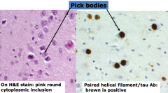 Pick Bodies: round cytoplasmic inclusion in neurons, contain abnormal tau filaments