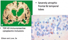 - Severely atrophic frontal and temporal lobes
- TDP-43 immunoreactive cytoplasmic inclusions
