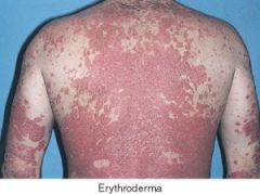 o   Rare life threatening, fever,
malaise, universal erythrema, scaling, most likely had chronic psoriasis