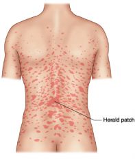 o   Acute eruption, lasts 4-10 weeks 
 o   Classic Herald Patch 
 o   1-2 weeks after Herald Patch,
exanthema on patients trunk and extremities, face is spared 
 o   Christmas tree pattern