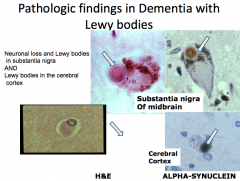 Both:
- Substantia nigra degeneration and Lewy bodies

DLB:
- Clinical features of dementia

PD:
- Parkinsonian signs and symptoms
- Most eventually develop dementia (5x more frequent than age-matched controls)
- Cortical Lewy Bodies