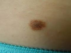 macule, tan, black, round
with smooth borders, always less than 1 cm, limited to epidermis