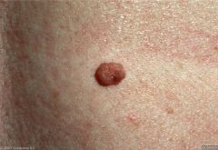 papule, nodule,, light to
black, my be smooth or cobblestone, always less than 1 cm, dermis and epidermis