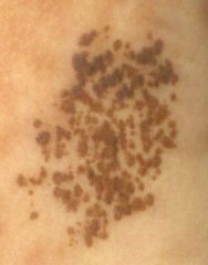 many dark brown macules or papules
scattered throughout pigmented background