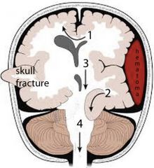 What kind of brain herniation is #1?